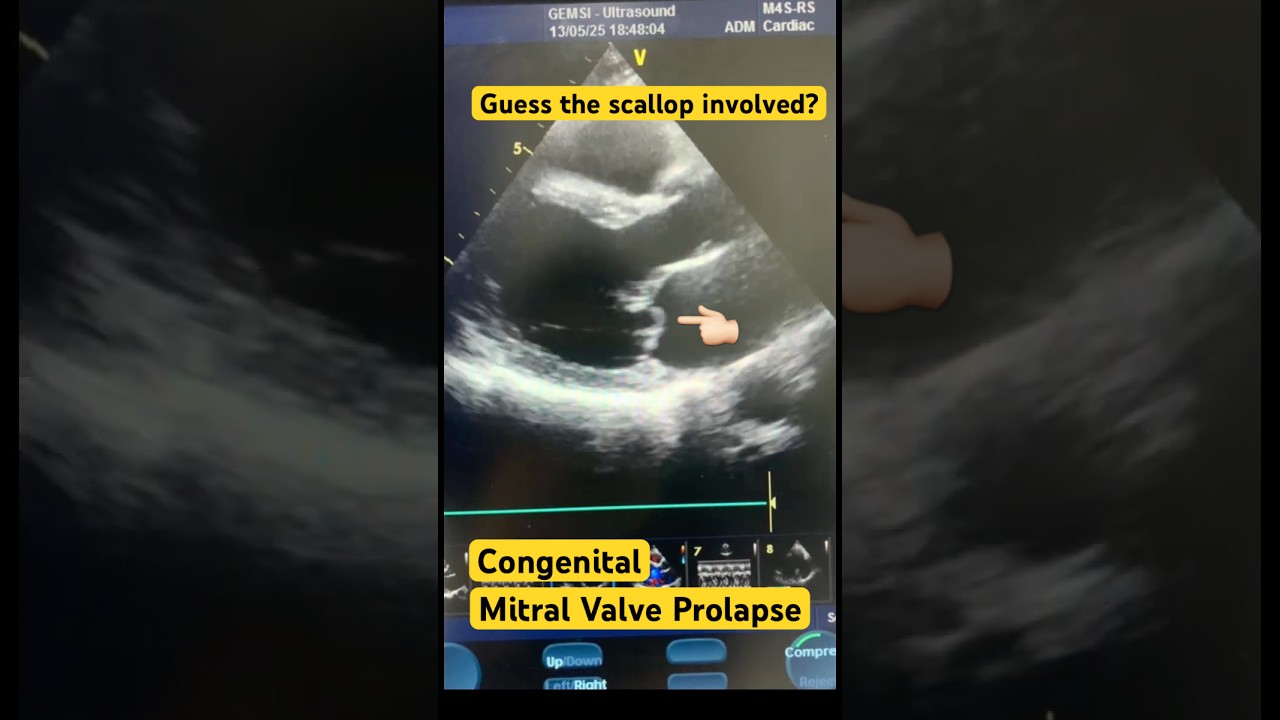Mitral Valve Prolapse on Echo || PML prolapse || Congenital MVP || Moderate MR || Dilated LA