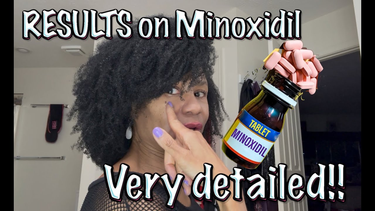 DETAILED Results of 12 months on Minoxidil. With photos and video clips. Part 2 of 3.