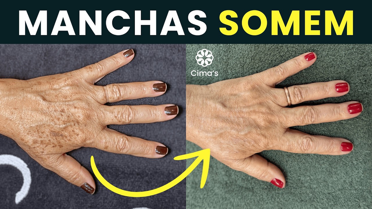 MANCHAS SENIS DESAPARECEM COM O MÉTODO CIMA'S | VEJA O ANTES E DEPOIS | TRATAMENTO EFICAZ