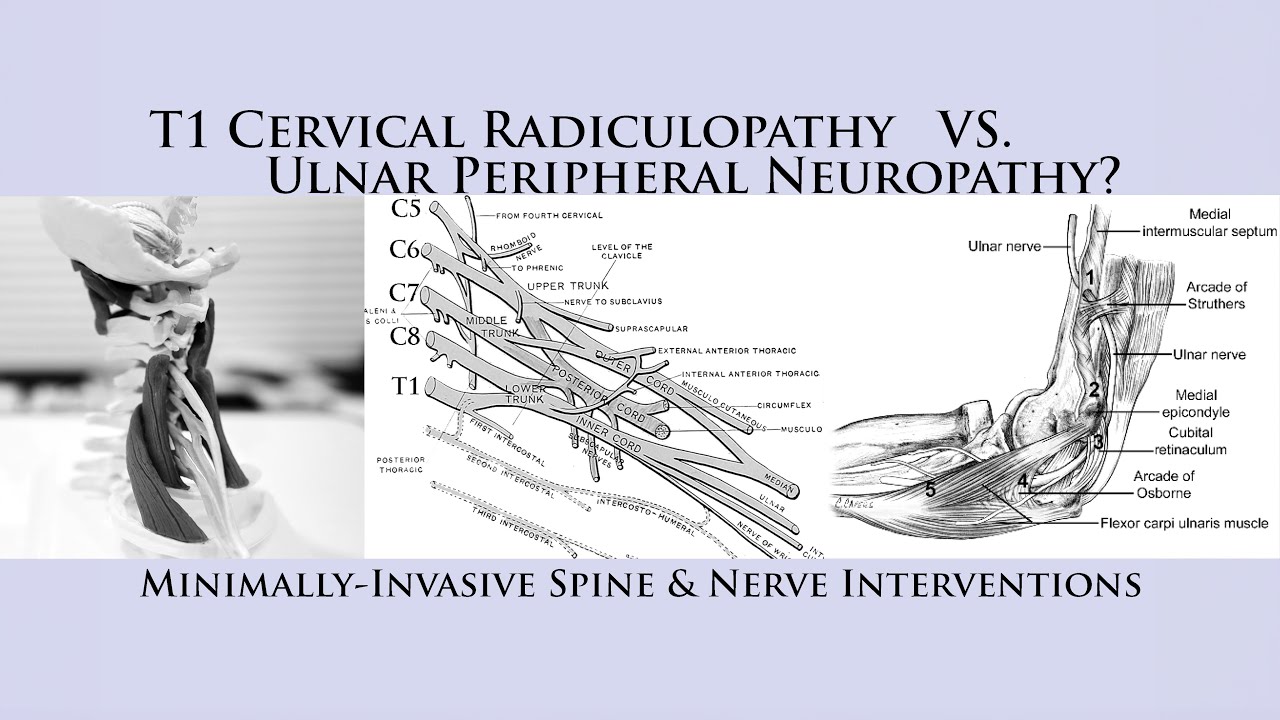 How to Differentiate T1 Cervical Radiculopathy vs Ulnar Nerve Neuropathy Cubital Tunnel Syndrome