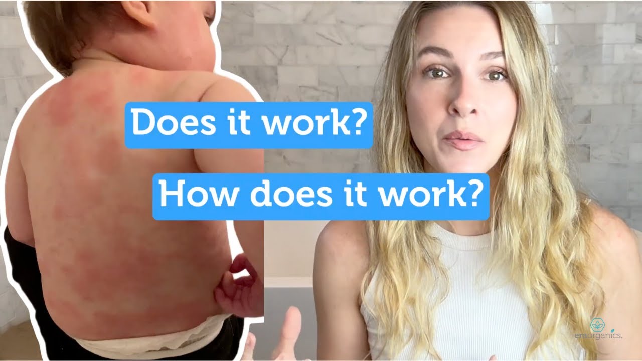 Hypochlorous Acid: A Natural Solution for Baby Eczema