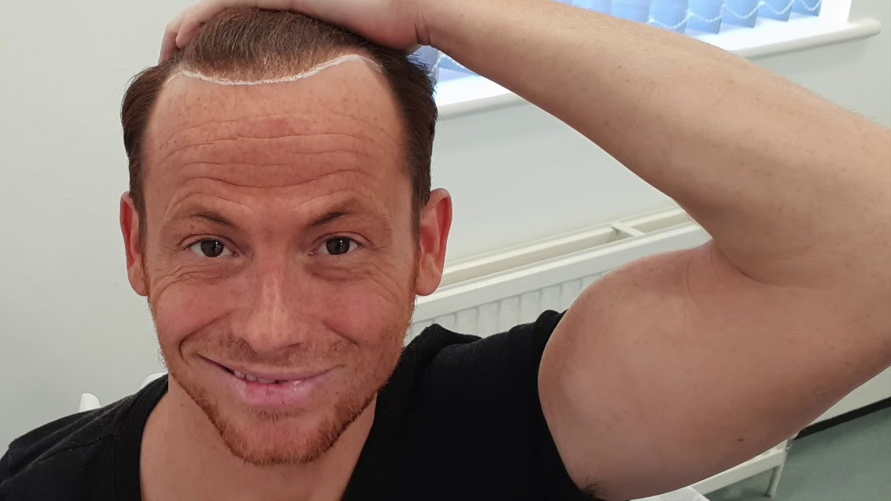 Joe Swash talking about his Hair Transplant with KSL Clinic..