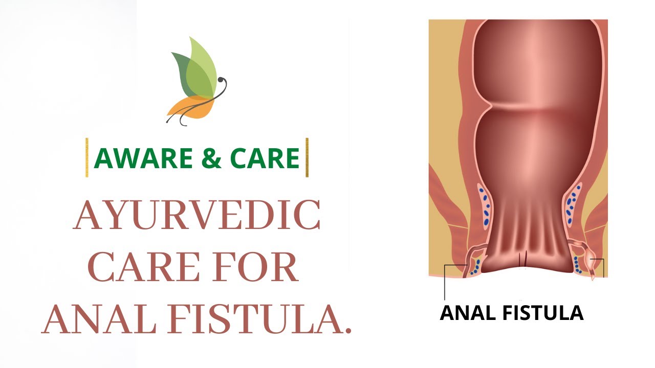 Santhigram Wellness 'Aware and Care' Episode 77 - Ayurvedic Care for Anal Fistula.