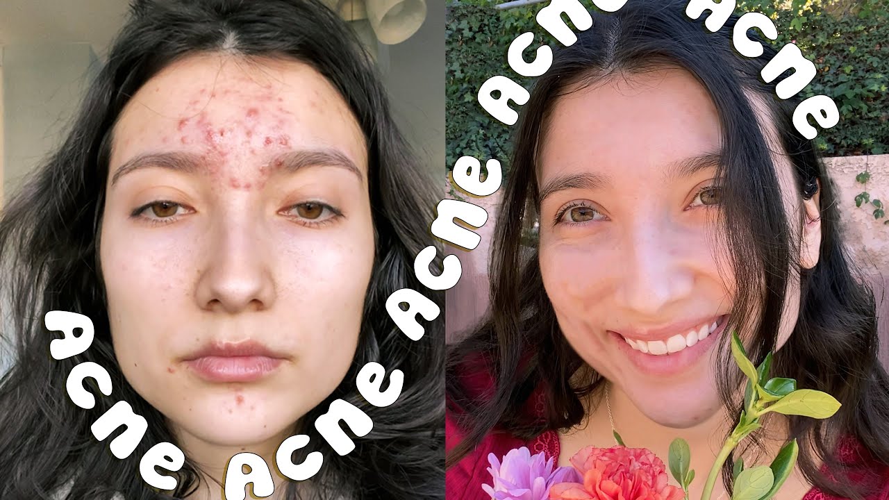 How I Finally Cured my Acne Obsession
