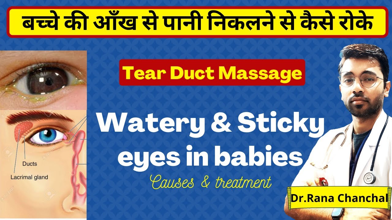 Sticky eyes in babies: Causes & treatment || Tear duct (NLD) Massage