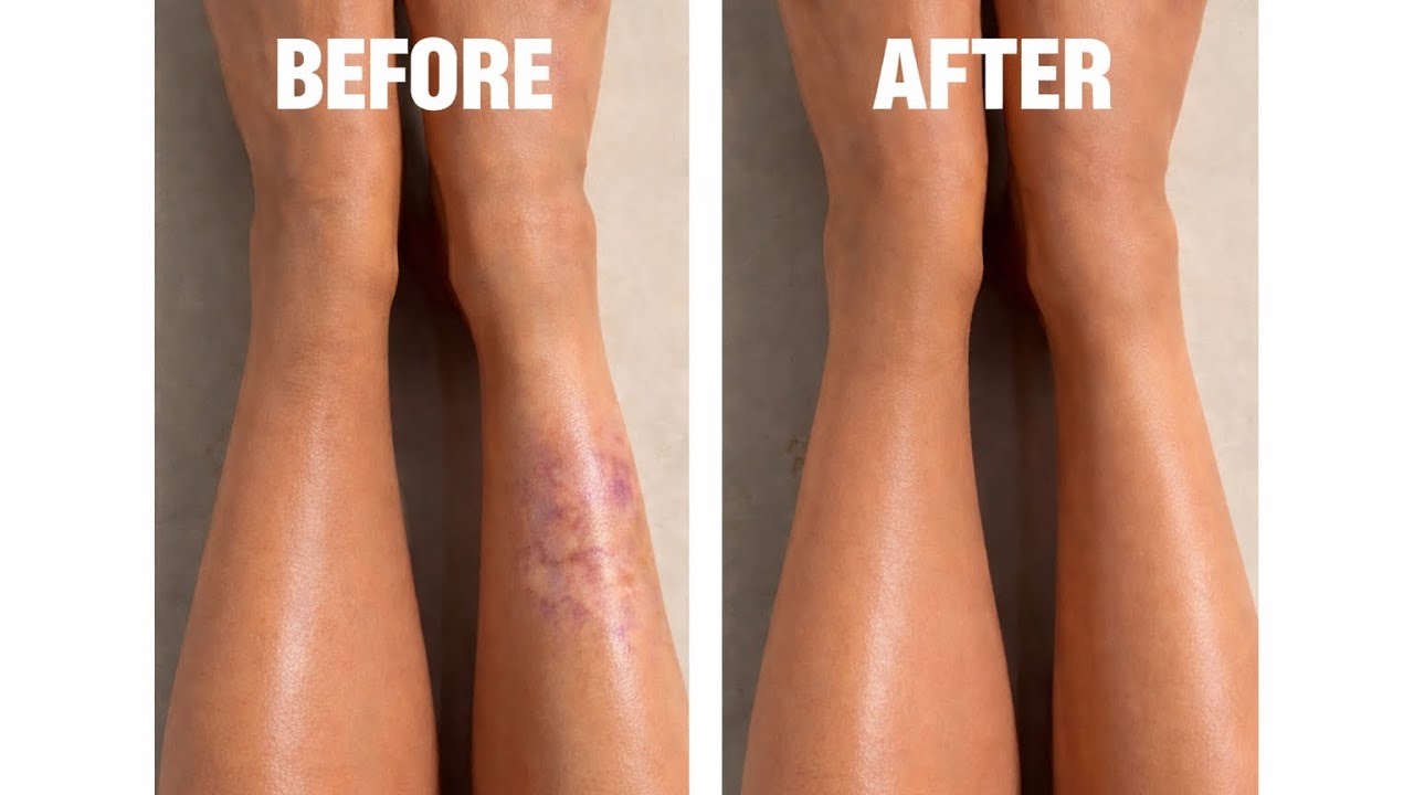 How to Cover Bruises on Skin | Body Coverage That Looks Real