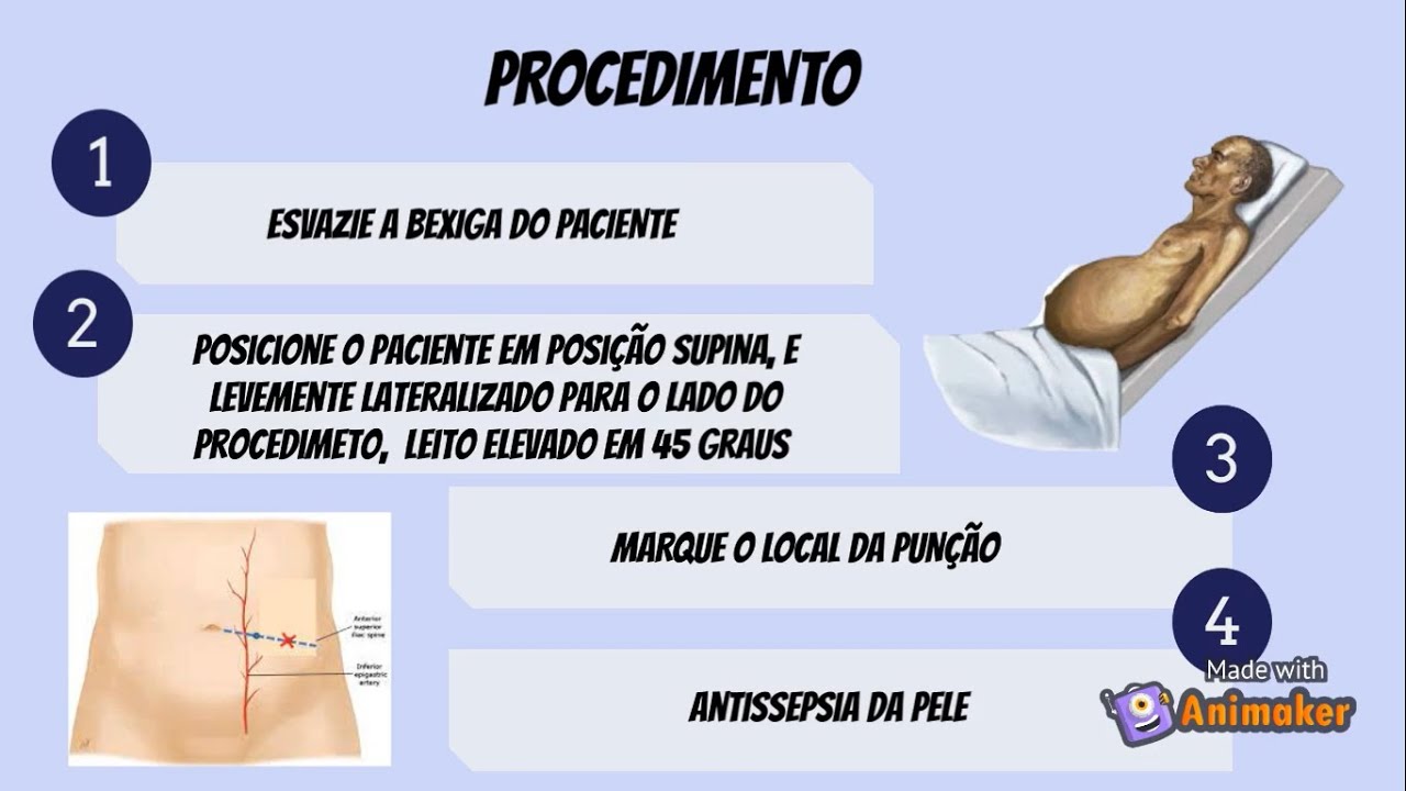 Paracentese - Prática Clínica Cirúrgica I - UNEB