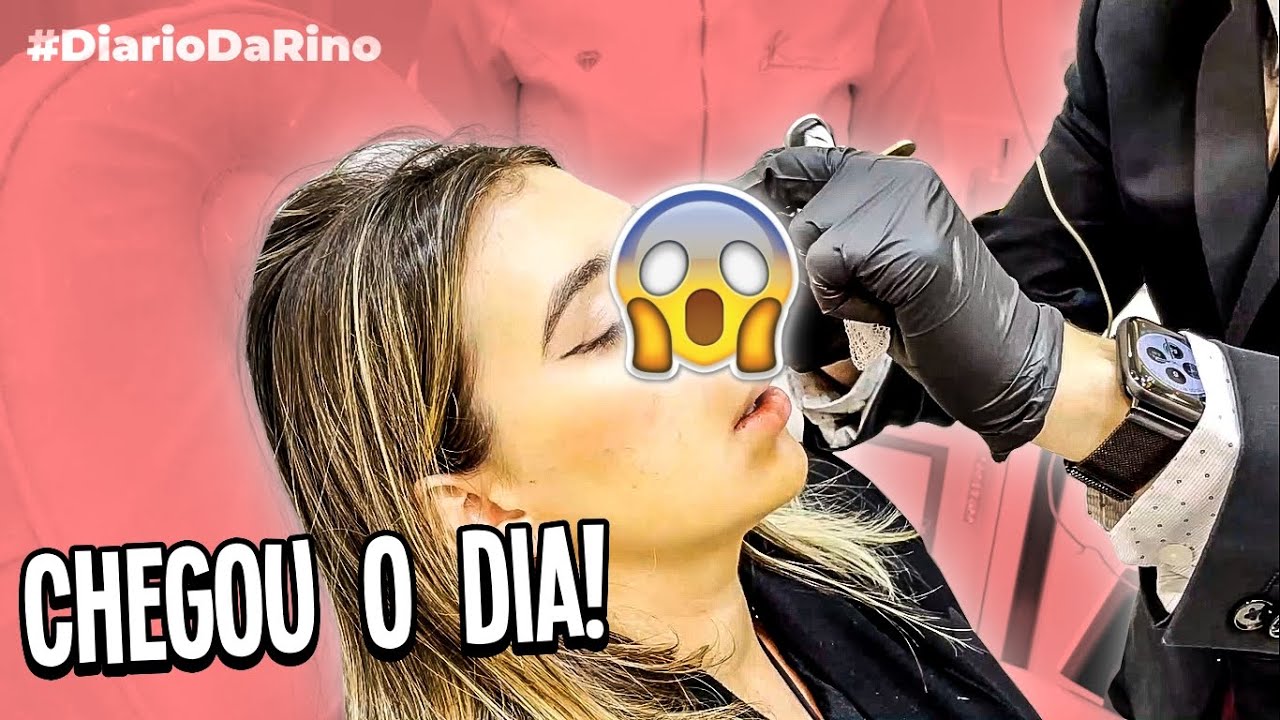 CHEGOU A HORA DE VER O RESULTADO! Diário da Rinoplastia!