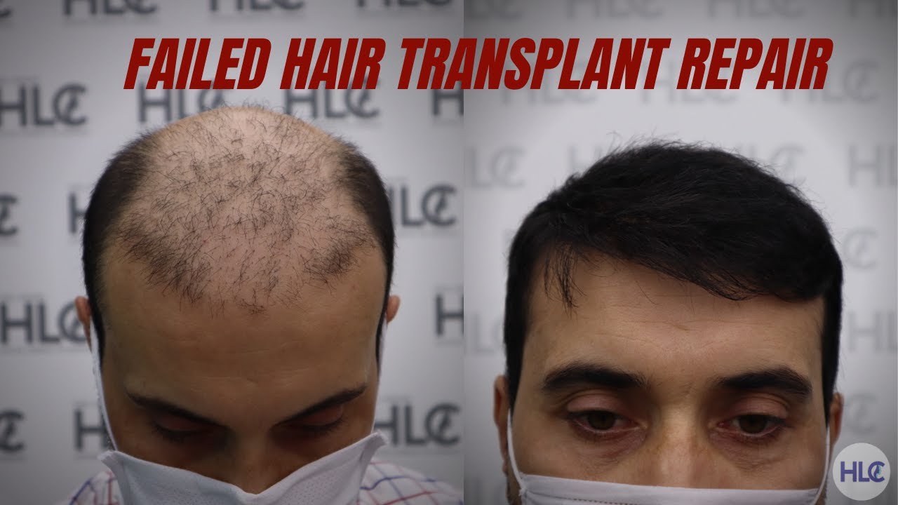 Failed Hair Transplant Repair, Hair transplant before and after