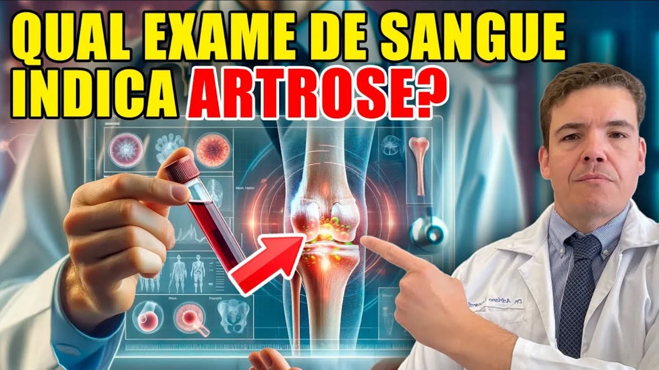 Exames de Sangue OBRIGATÓRIOS para diagnosticar ARTROSE