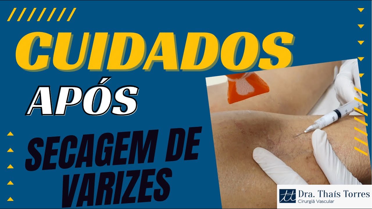 Cuidados após secagem de varizes ( escleroterapia ou aplicação )