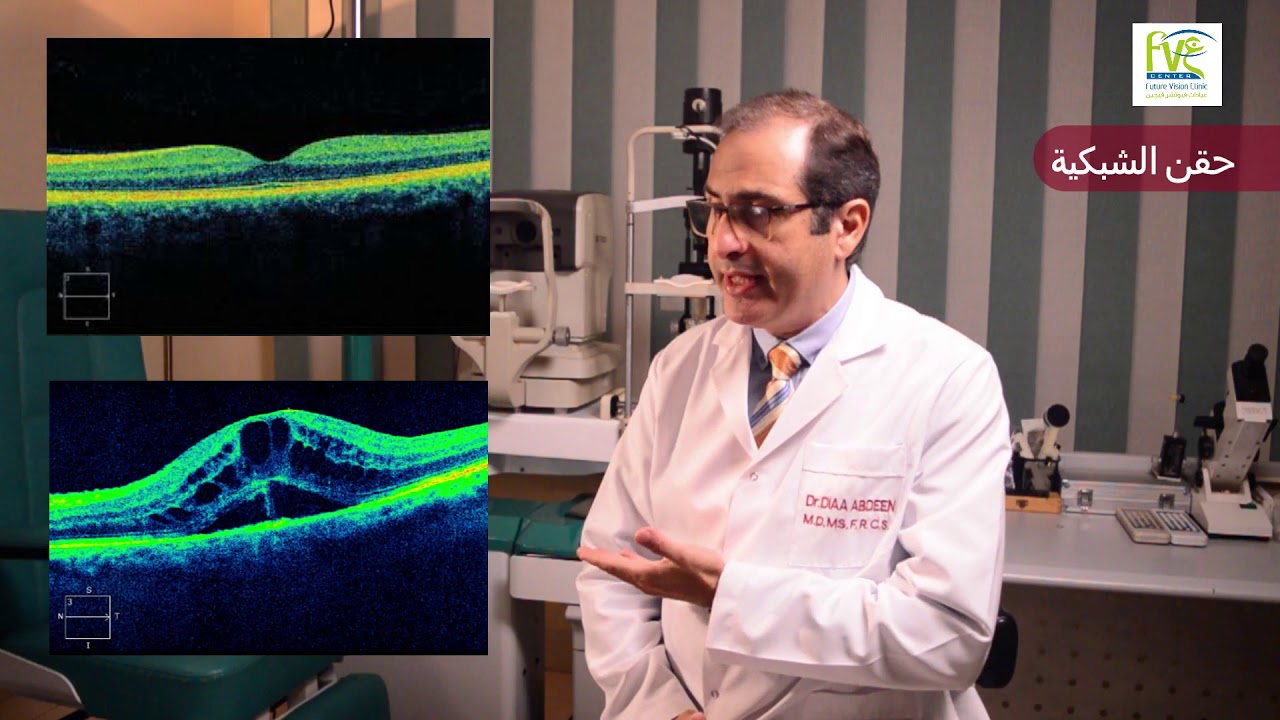 علاج إرتشاح و نزيف الشبكية عن طريق الحقن الدوائي