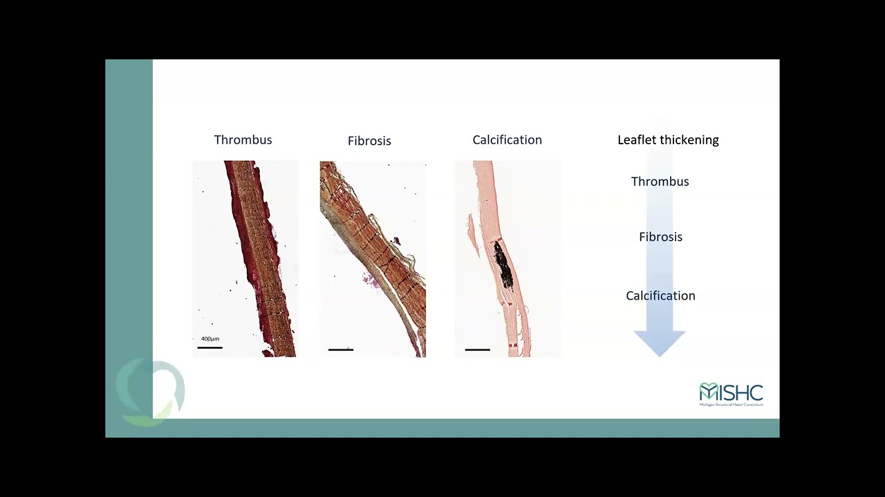 Dr. Sellers Presents TAVR Translational Science: Insights to Degeneration, Durability, & Redo TAVR"