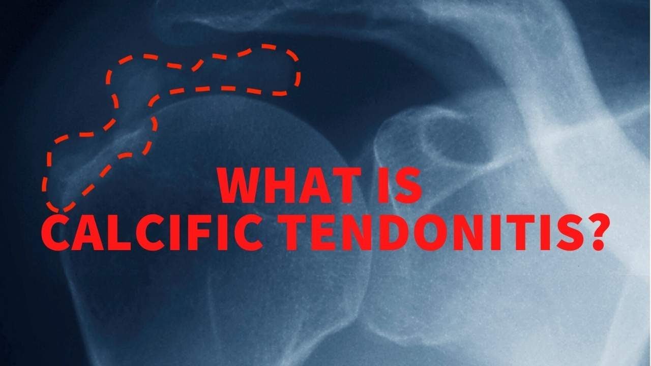 What is calcific tendonitis?