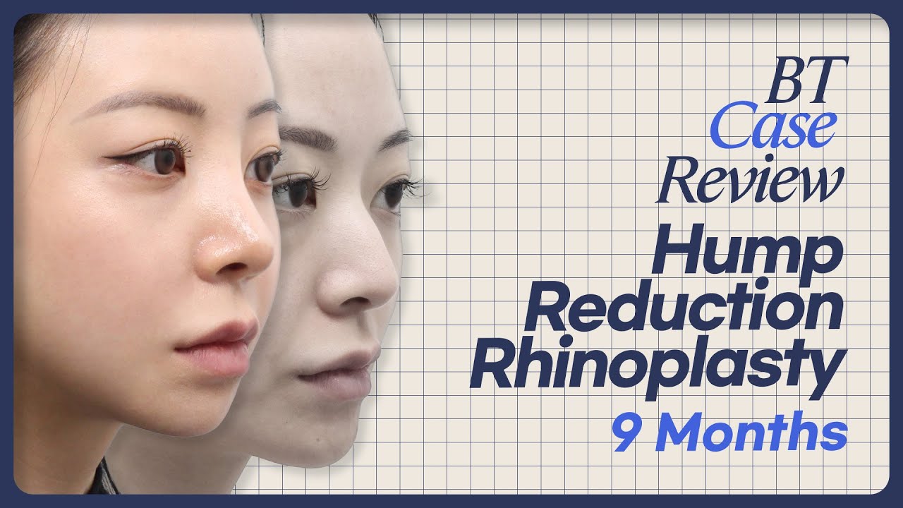 Hump Reduction Rhinoplasty in Korea Before and After | BT Plastic Surgery Clinic Case Review