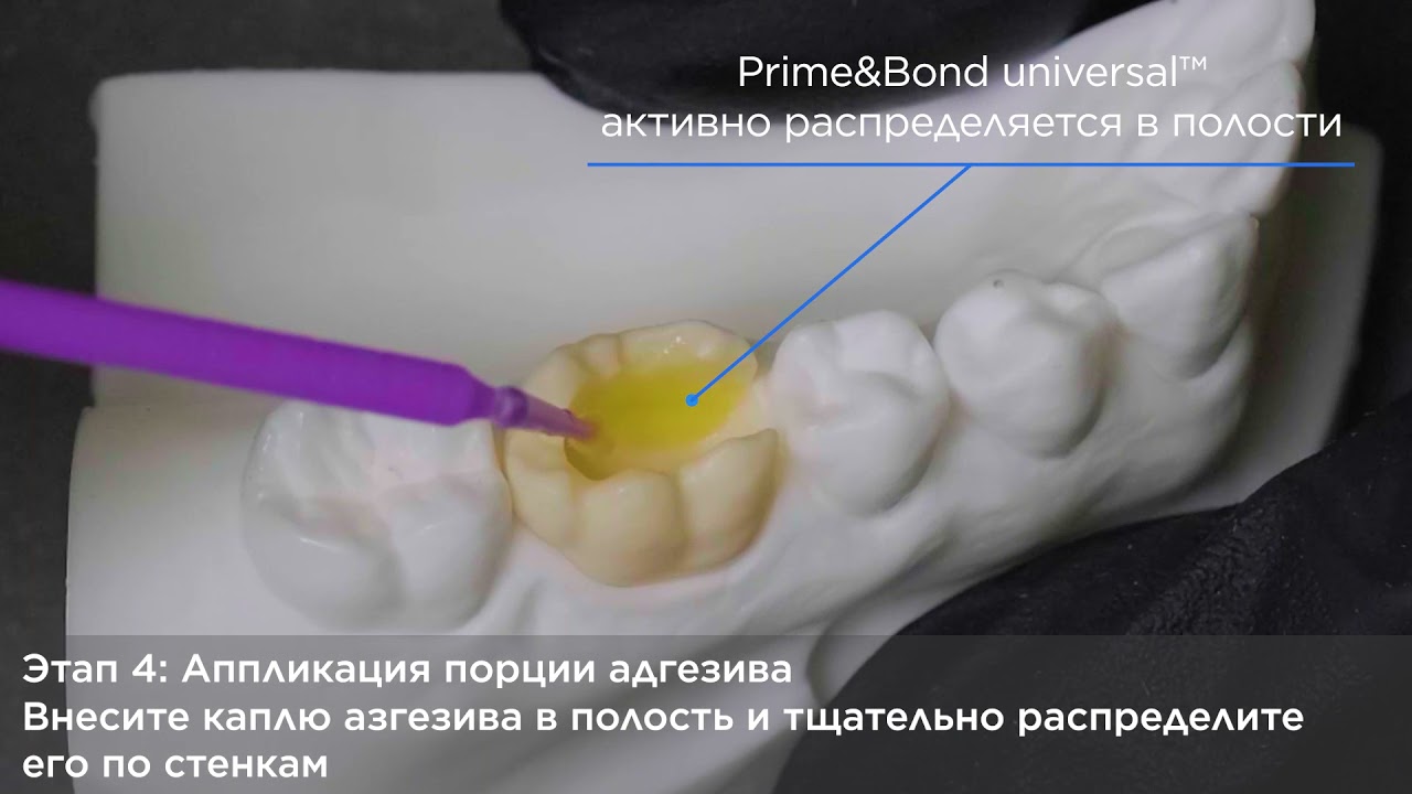 Prime&Bond universal: адгезивный протокол в технике селективного протравливания