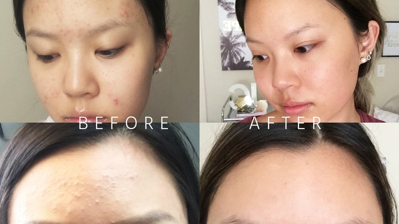 Taking Accutane for the SECOND Time • My Experience