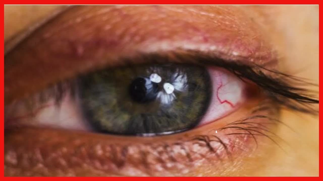Tr&auml;nende Augen: Was sind die Ursachen?
