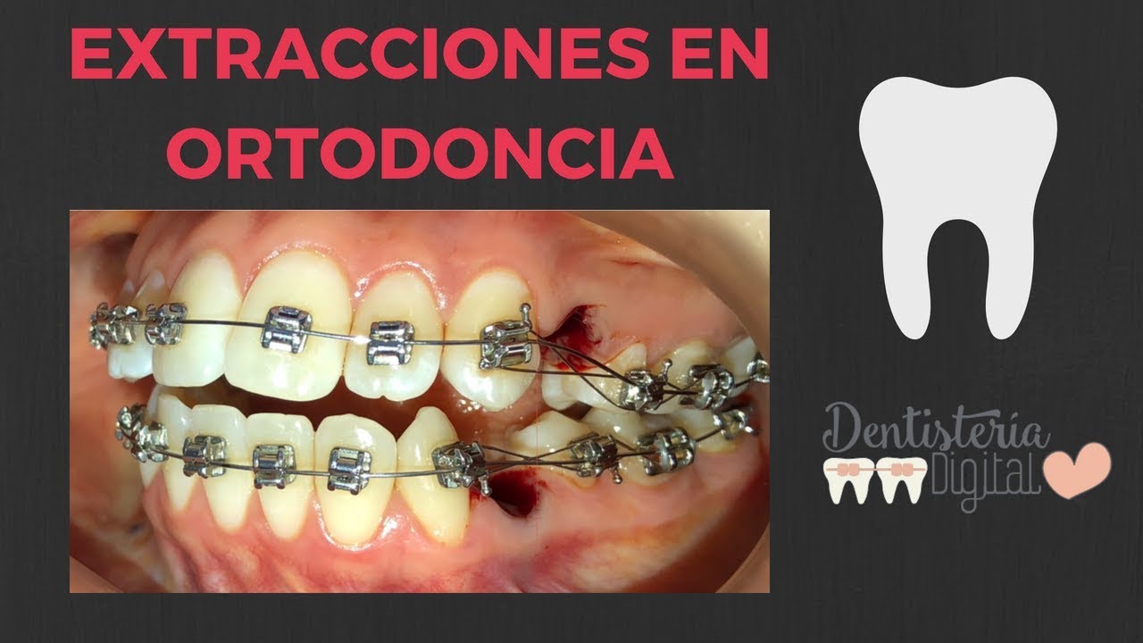 Extracciones en Ortodoncia - ¿Quién las necesita?