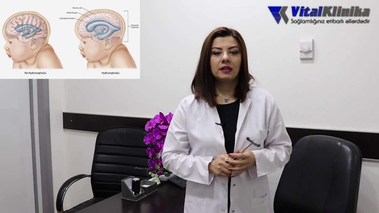 Vital Klinika--Uşaq nevroloqu Təranə Quliyeva--HİDROSEFALİYA