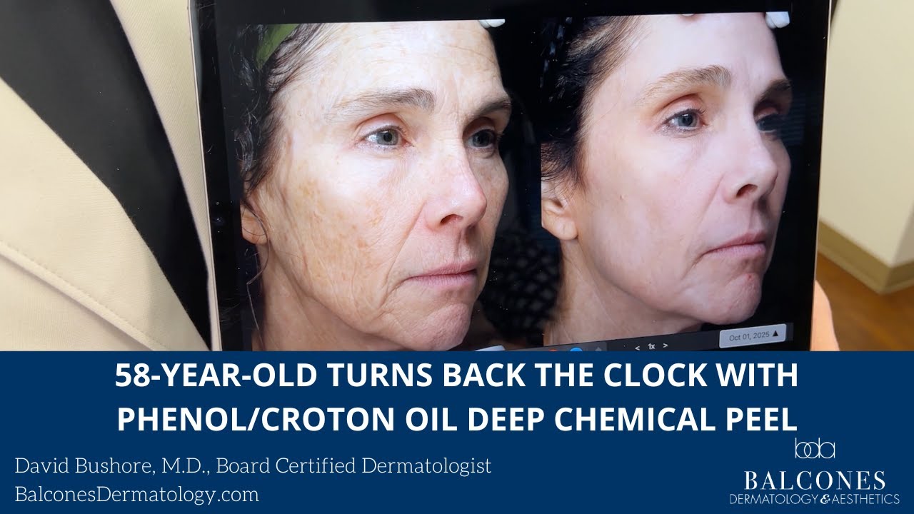58-Year-Old Turns Back the Clock with Phenol/Croton Oil Deep Chemical Peel | Dr. David Bushore