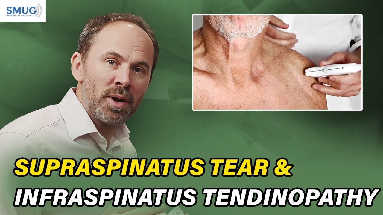 Разрыв надостной мышцы и тендинопатия подостной мышцы — больше не упускайте их из виду!