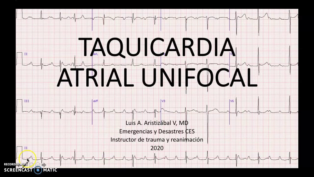 TAQUICARDIA AURICULAR UNIFOCAL LUIS ARISTIZABAL ANESTESIAR