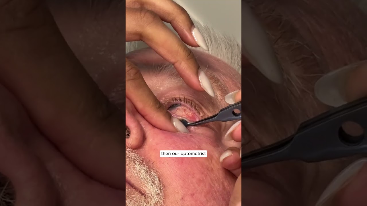 Island Eyecare's Dry Eye Treatment