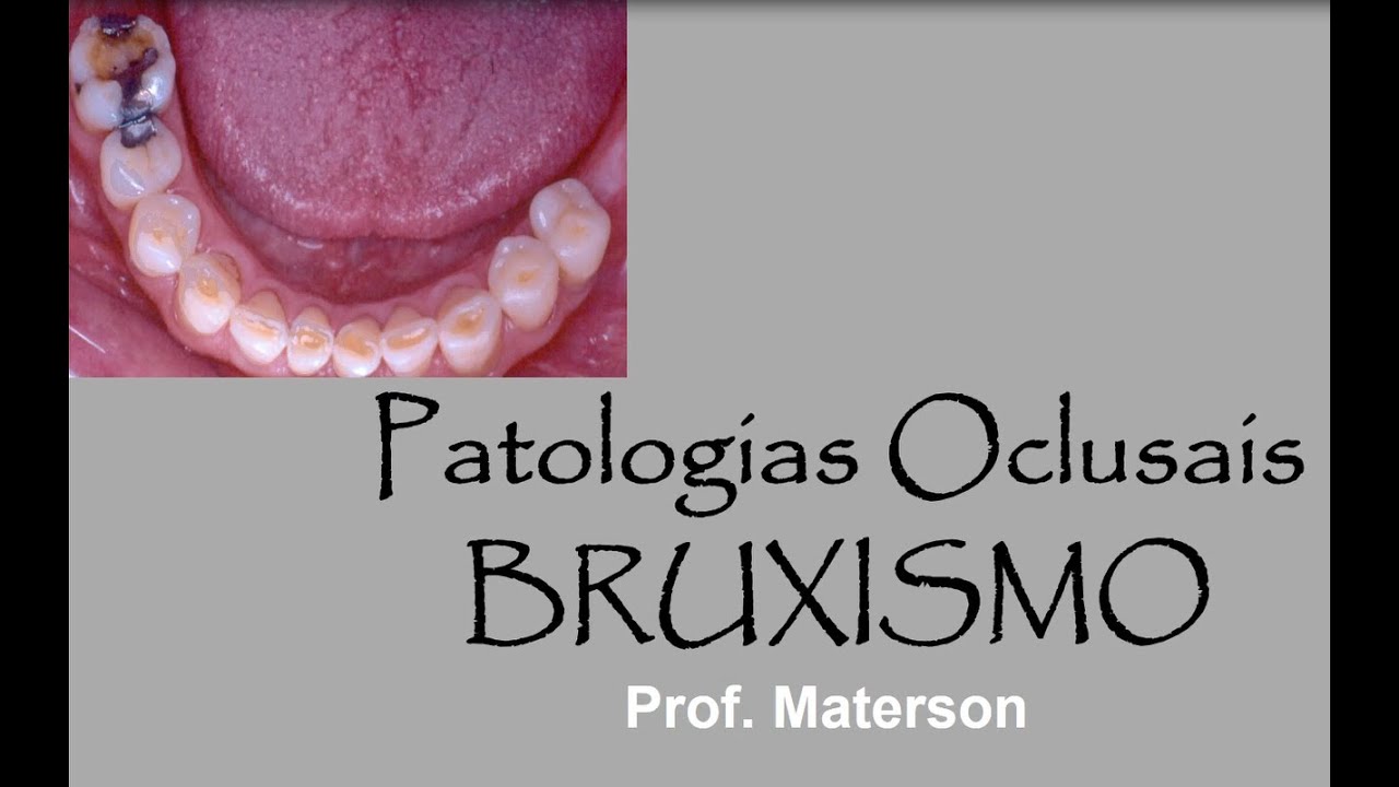 OCLUSAO em 20 minutos - PATOLOGIAS OCLUSAIS