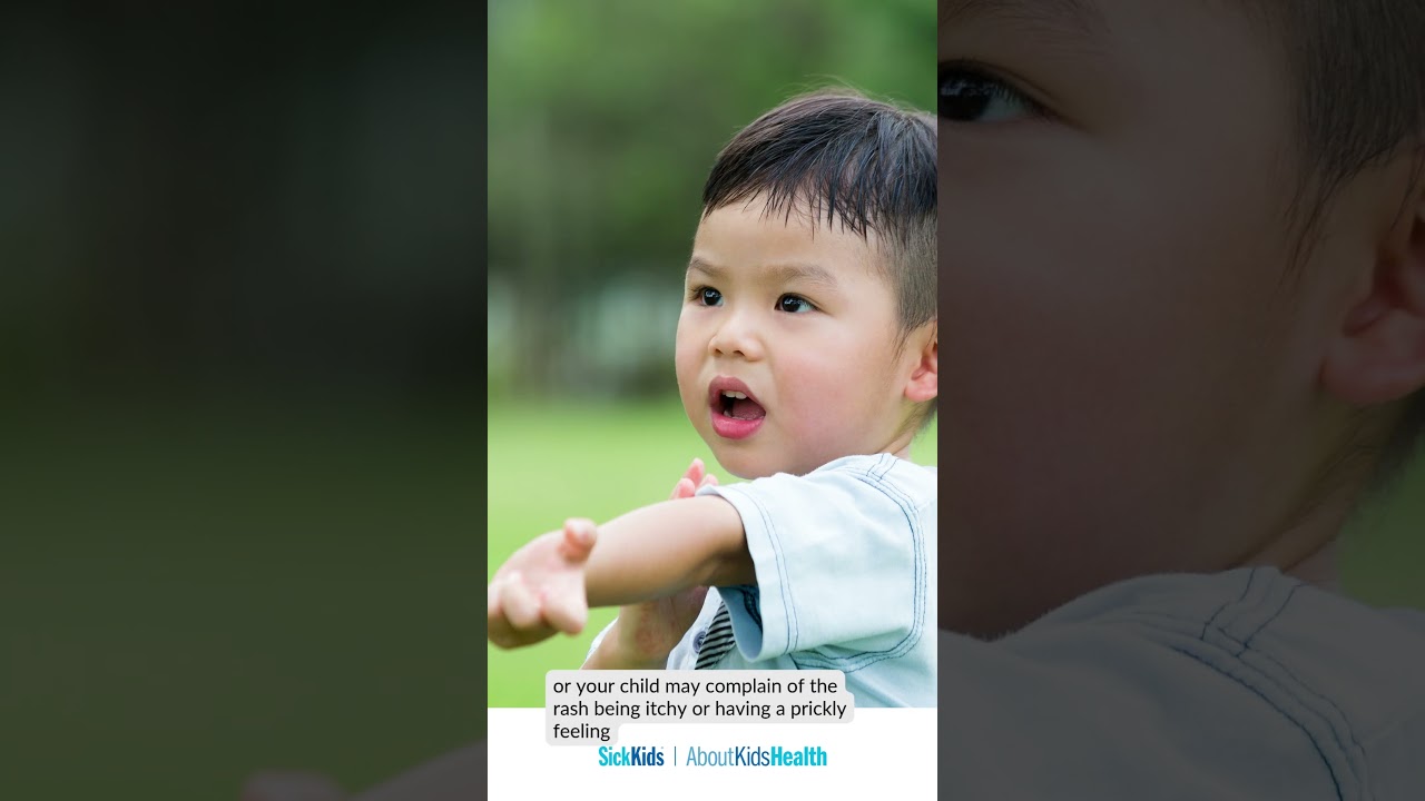 Prevention and treatment of heat rash in kids | AboutKidsHealth at The Hospital for Sick Children