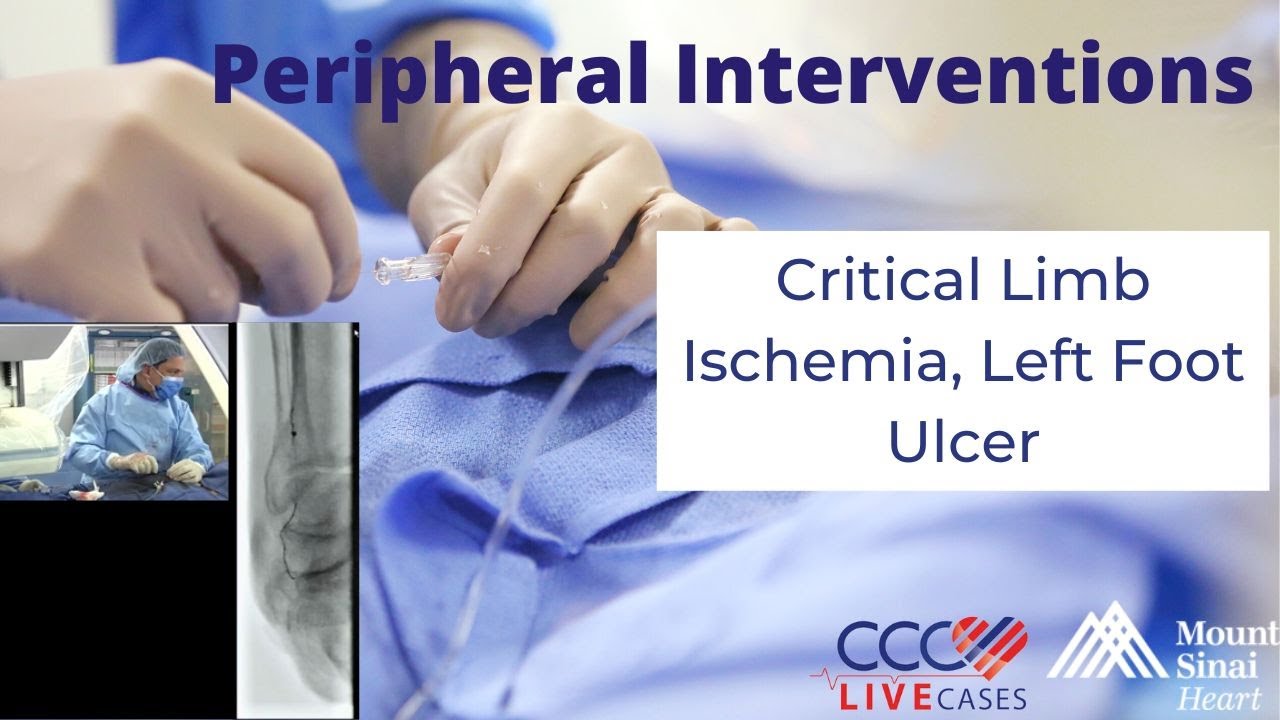 Critical Limb Ischemia, Left Foot Ulcer &ndash; December 2017
