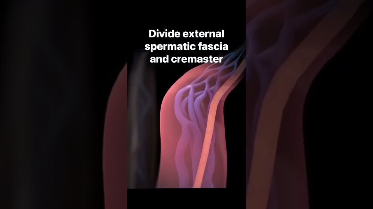 Microscopic varicocelectomy