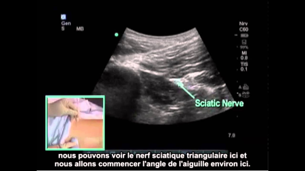 Comment : Réaliser un bloc du nerf sciatique sous-glutéal par guidage échographique