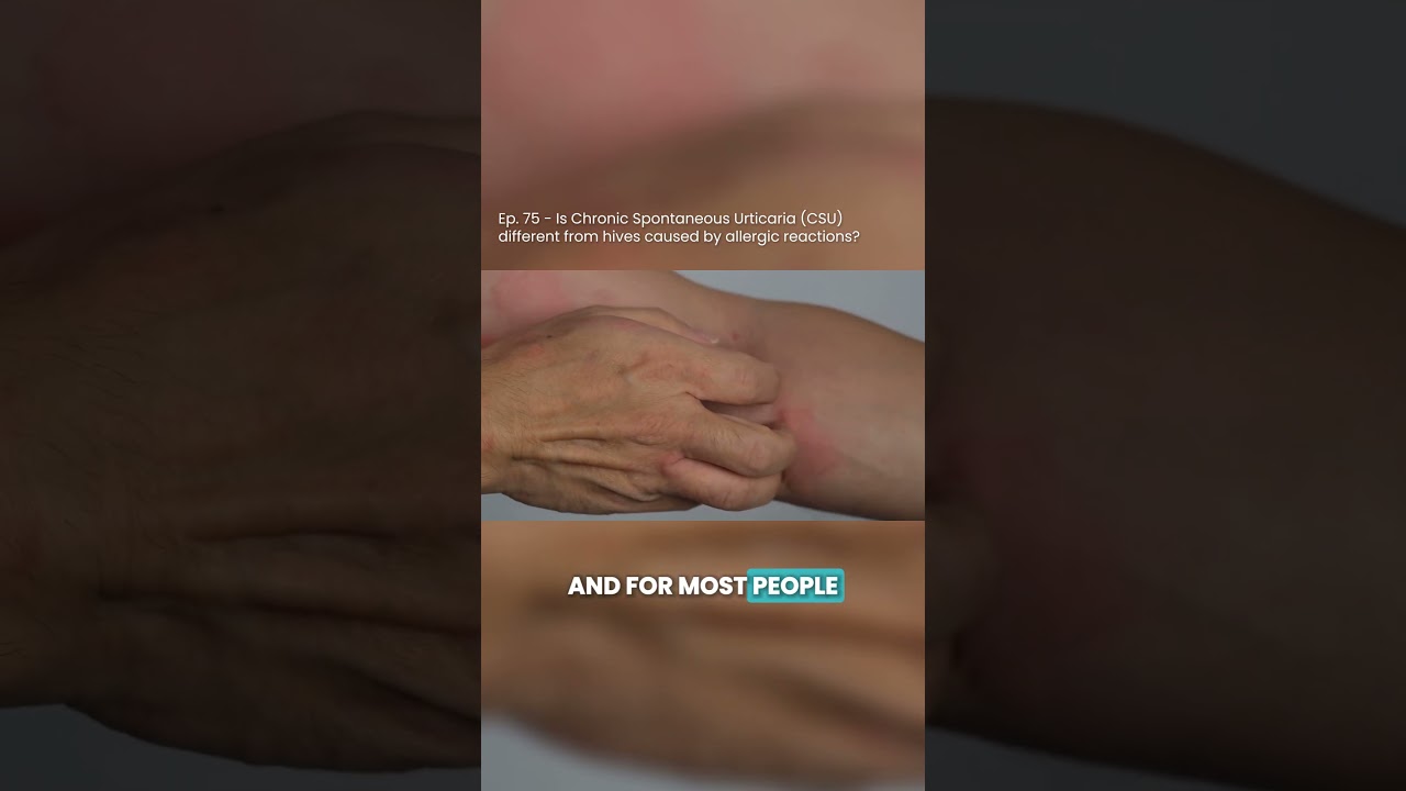 Is Chronic Spontaneous Urticaria (CSU) different from hives caused by allergic reactions?