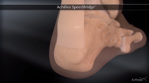 Achilles SpeedBridge&trade;