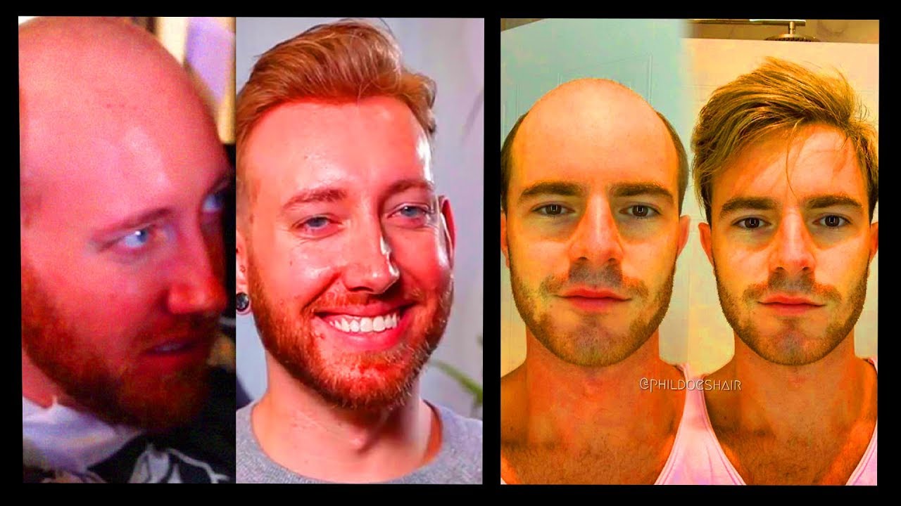 More Balding Guys Trying Out Non-Surgical Hair Replacements By Phil Ring