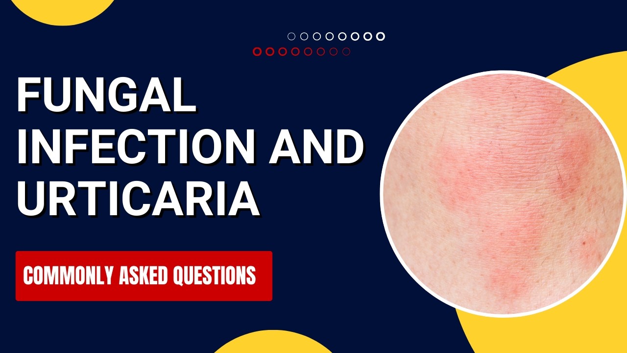 Skin Fungal Infection and Urticaria