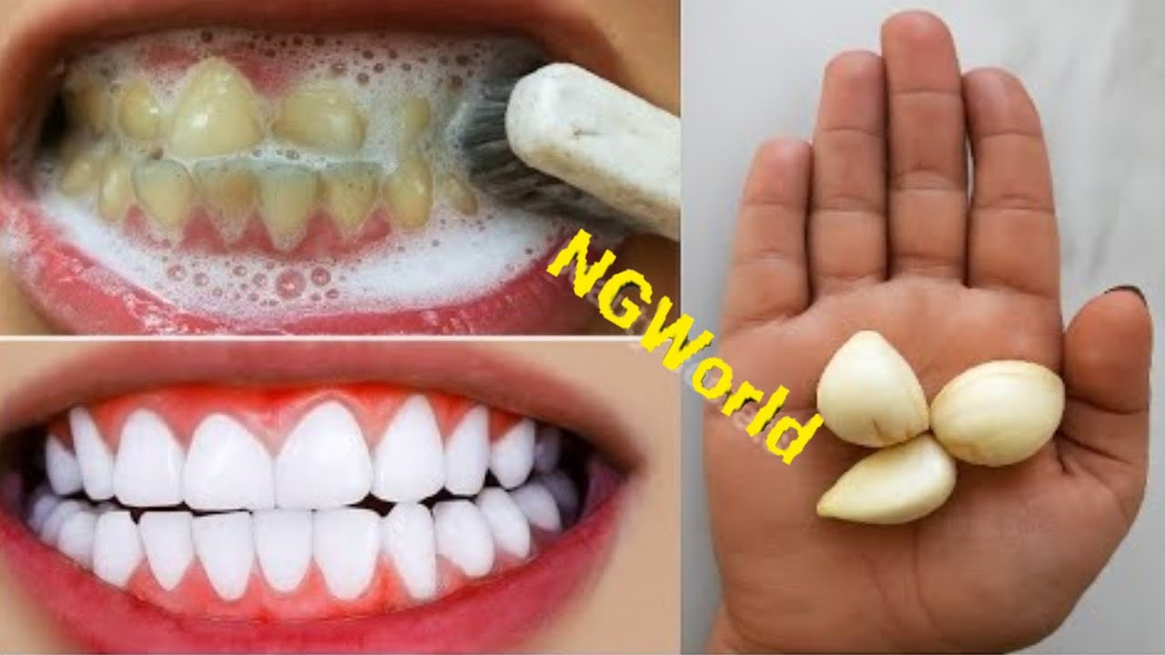 The recipe that dentists are hiding from us 🔥!It whitens teeth and eliminates tartar in 1 minutes.
