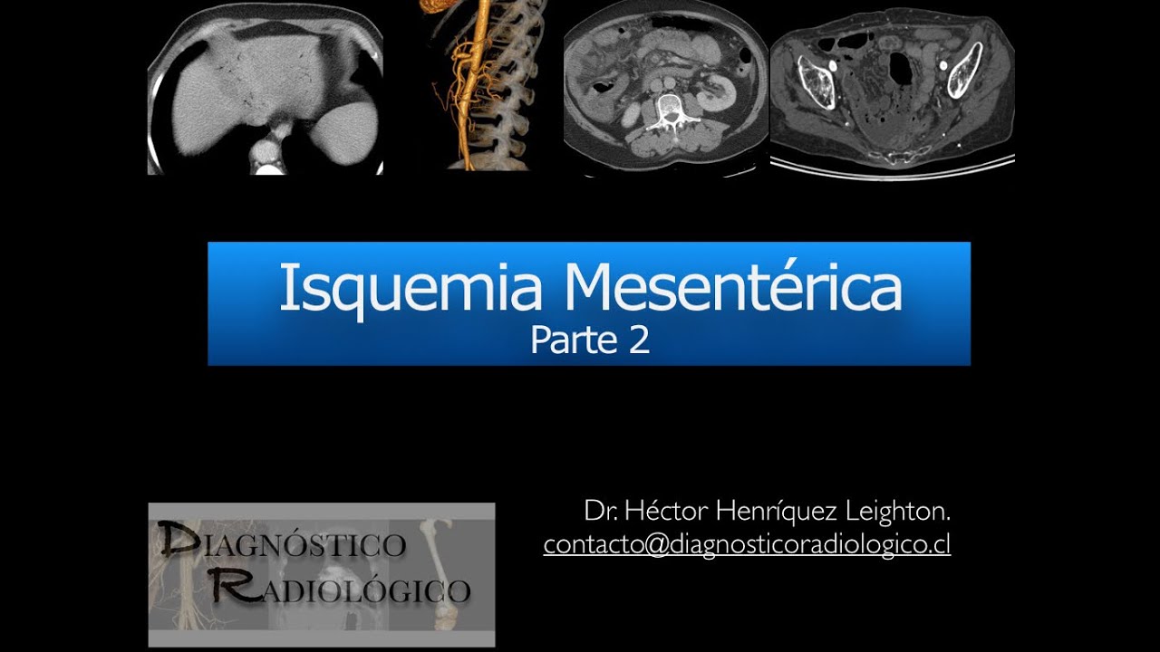 Isquemia Mesentérica Parte 2