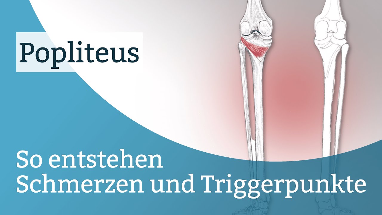 Popliteus Schmerzen, Triggerpunkte und deren Aktivierung
