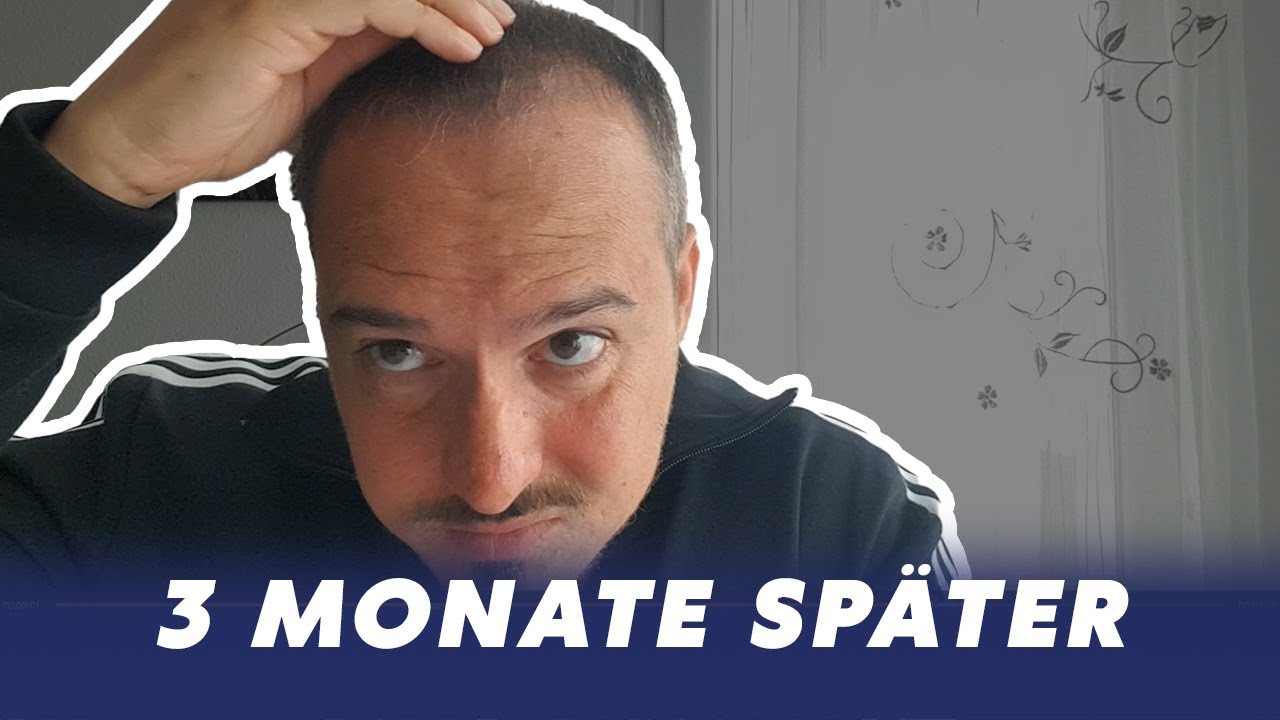 Haartransplantation (3 Monate später )