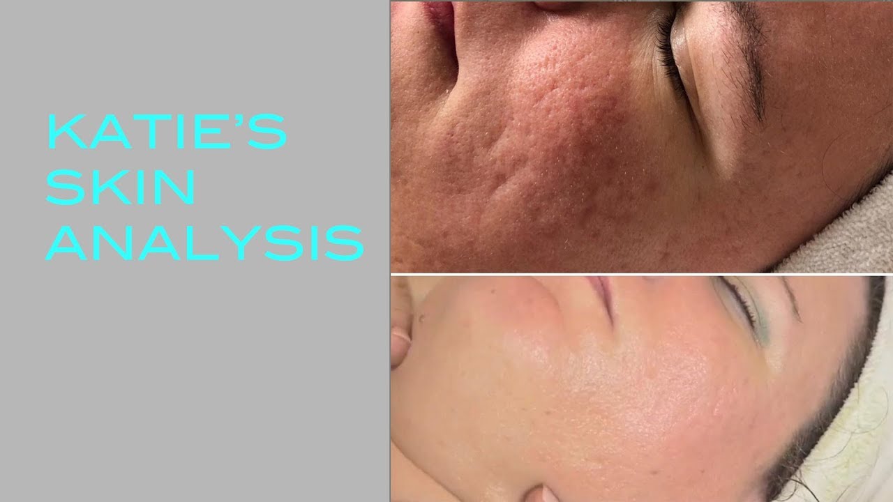 Katie's Skin Analysis