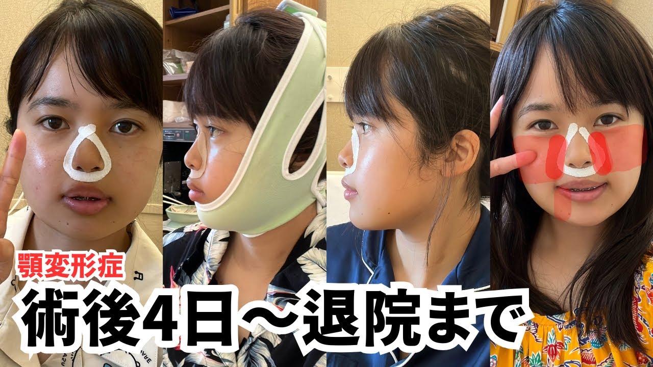 【顎変形症】【両顎手術】術後4〜8日目退院まで