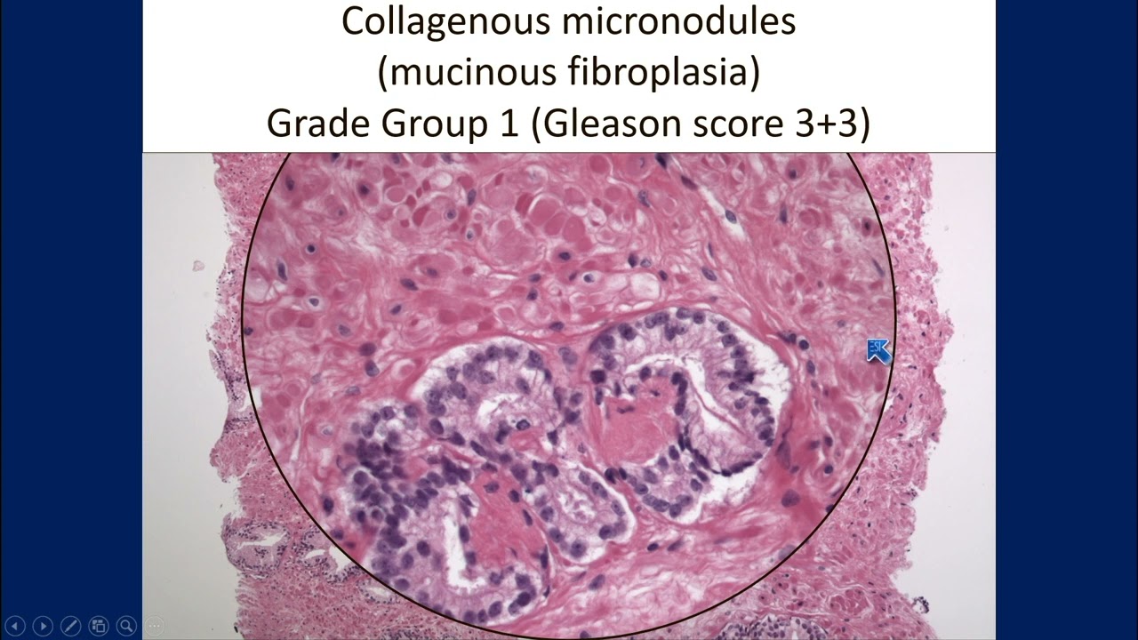 2023 Surgical Pathology Update: Diagnostic Pearls for the Practicing Pathologist: Vol. VII