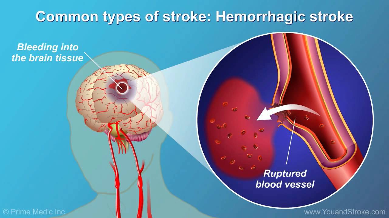 Understanding Stroke