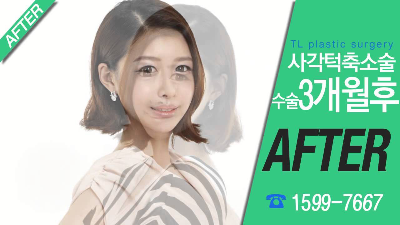 [TL Plastic Surgery Korea] Facial Contouring Center: Square Jaw Reduction