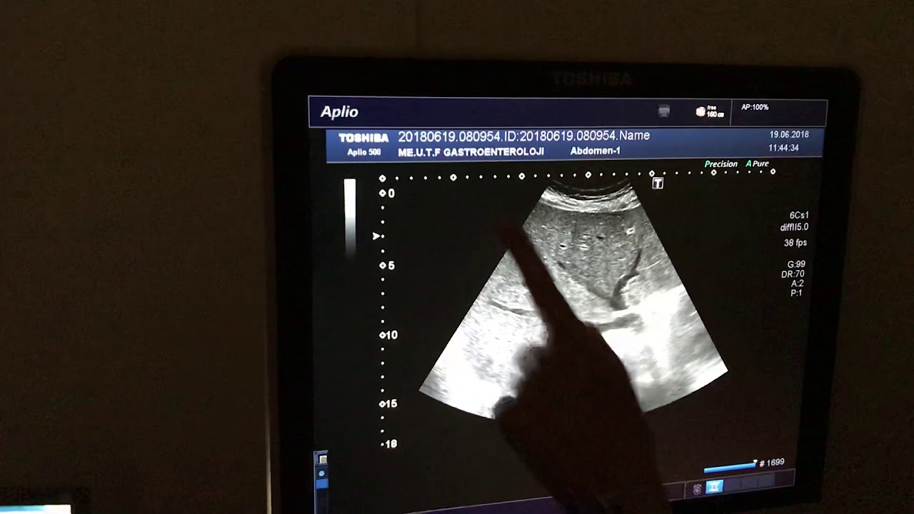 Karaciğer segmentleri, ultrasonografik olarak karaciğer parçaları,karaciğer ultrasonu. Lebersegmente