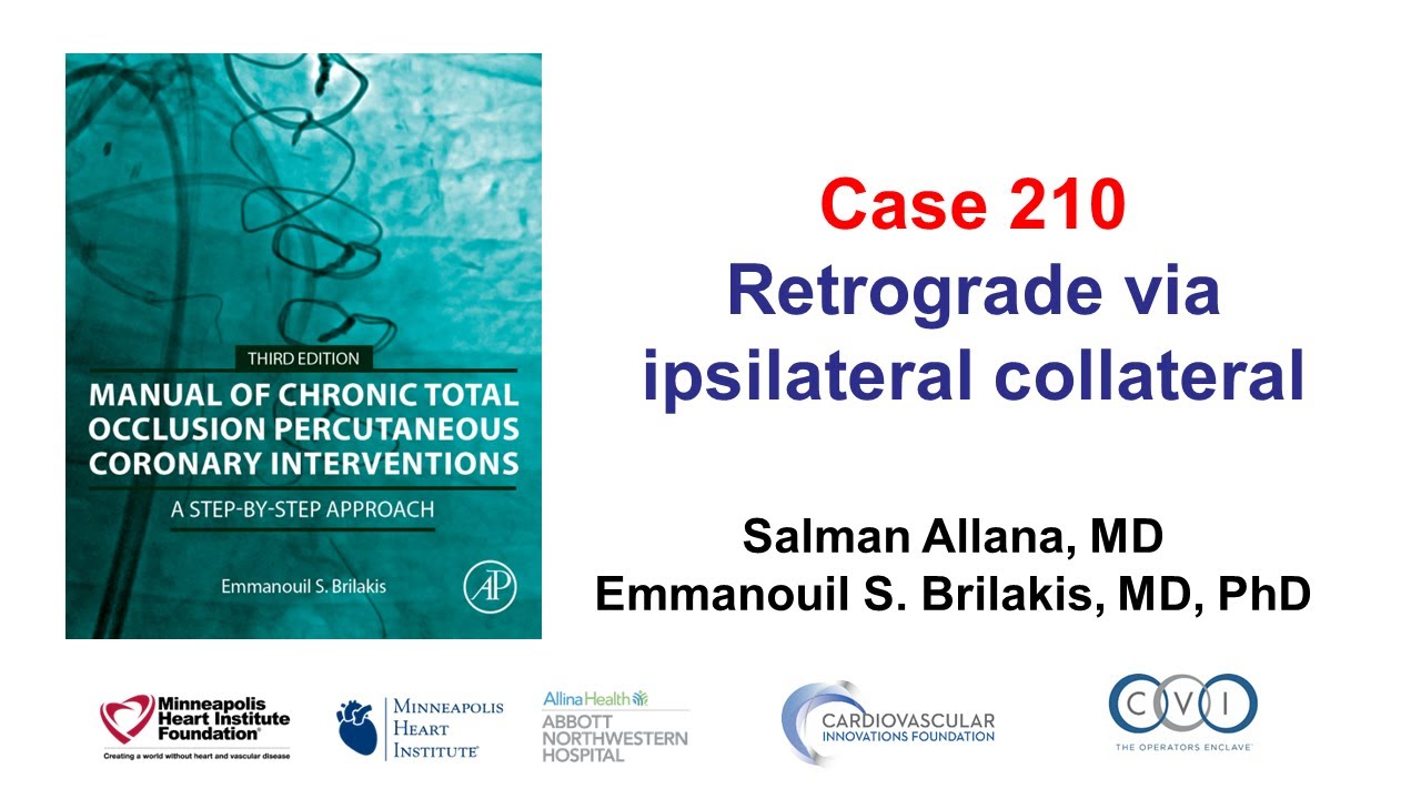 Case 210: Manual of CTO PCI - Retrograde via ipsilateral collateral