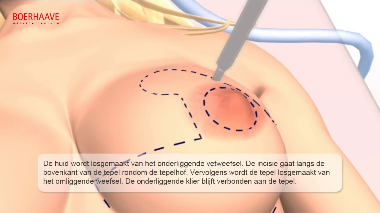 Borstverkleining Animatie - Boerhaave Medisch Centrum