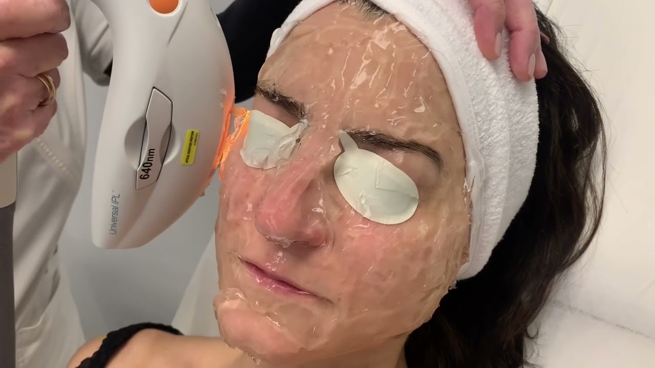 IPL (luz pulsada intensa) . Rejuvenecimiento facial y de escote